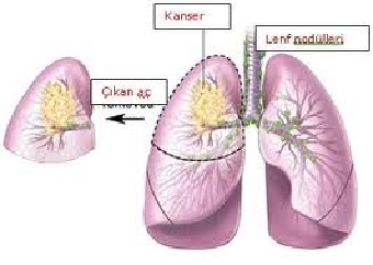 lobektomiya