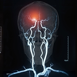 neyroangiografiya-i-stentirovanie