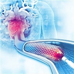 koronarnaya-angioplastika-i-stentirovanie-v-turcii