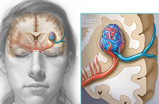arteriovenoznaya-malformaciya-golovnogo-mozga
