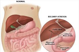 biliarnaya-atreziya
