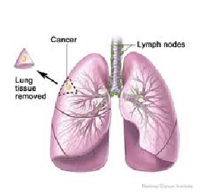 klinovidnaya-rezekciya