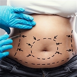 abdominoplastika-jivota
