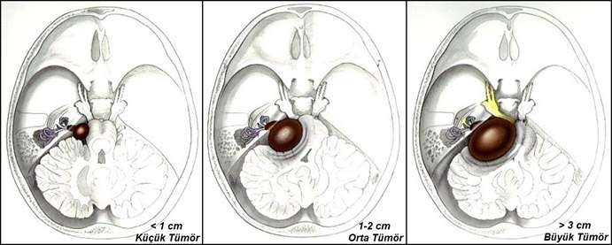 nevrinoma-sluhovogo-nerva-lechenie