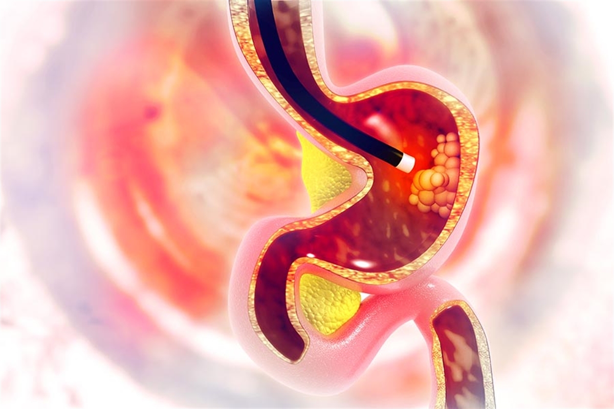 endoskopiya-v-turczii