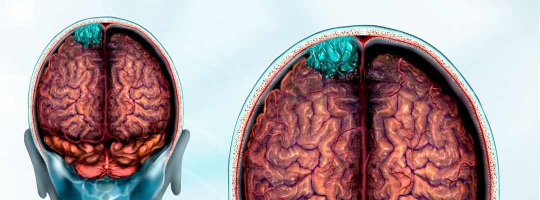 meningioma-golovnogo-mozga