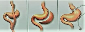 hirurgicheskoe-lechenie-ozhireniya