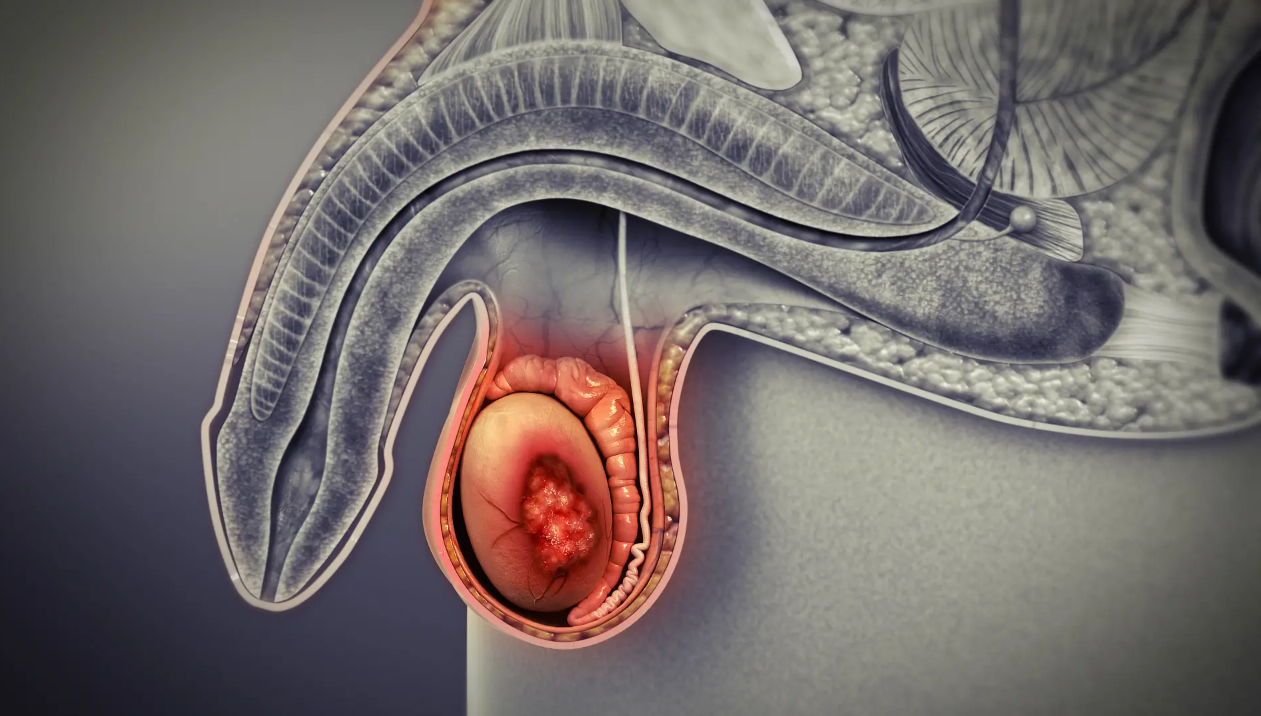 rak-yaichka-lechenie