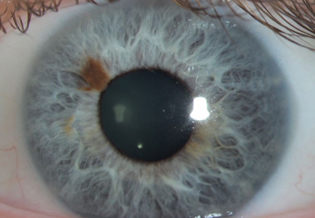tmelanoma-glaza