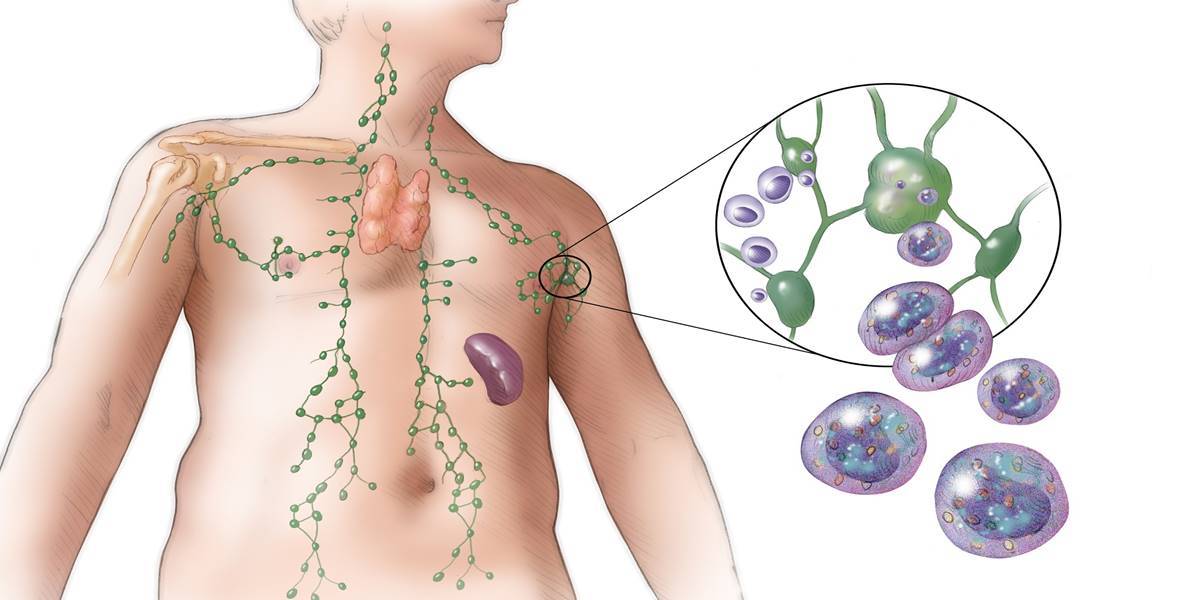 limfoma-simptomy-i-lechenie