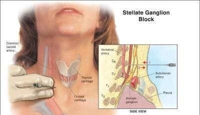 blokada-zvezdchatogo-gangliya