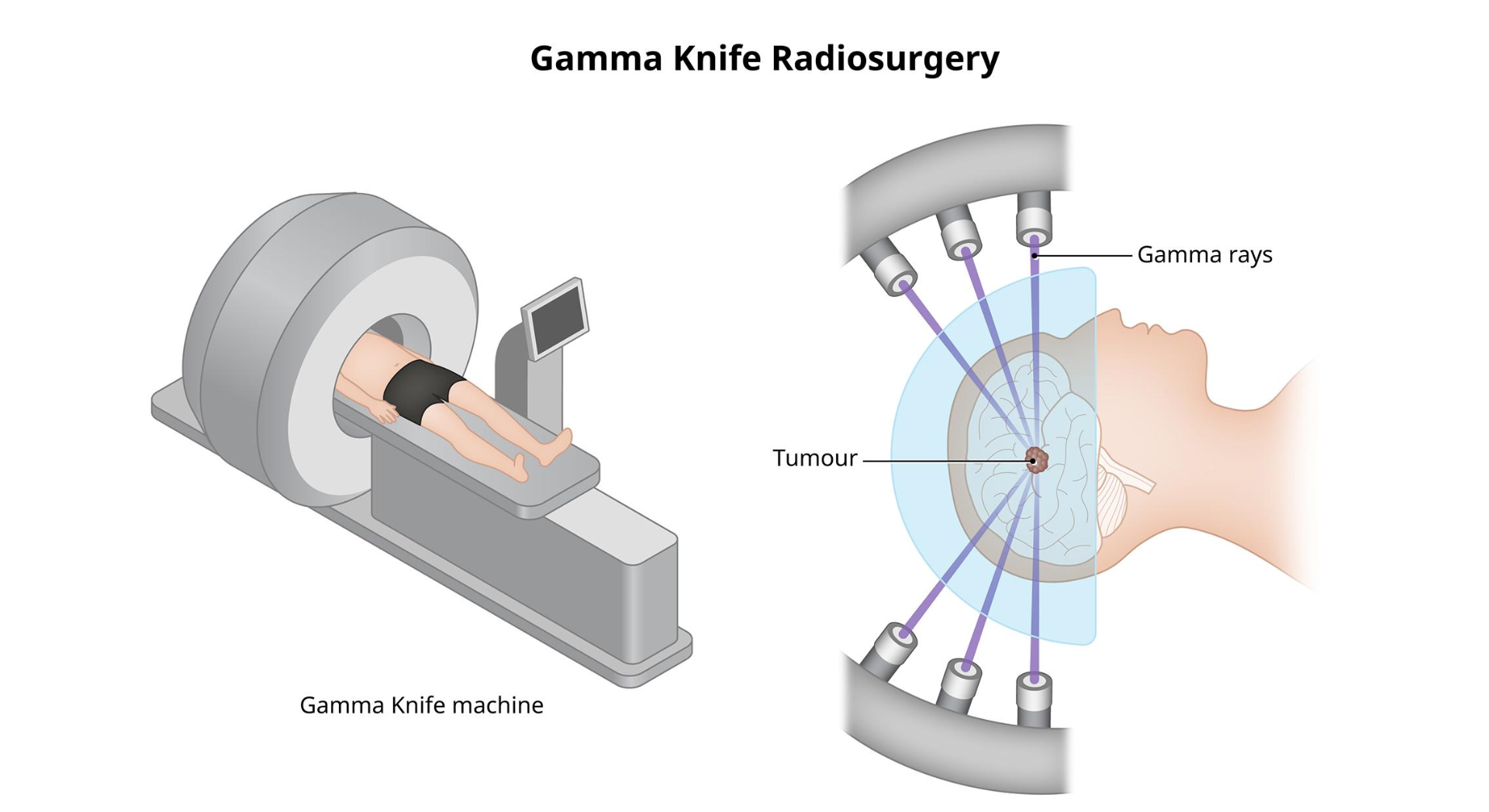 terapiya-gamma-nozhom-pri-metastazah-v-golovnoj-mozg