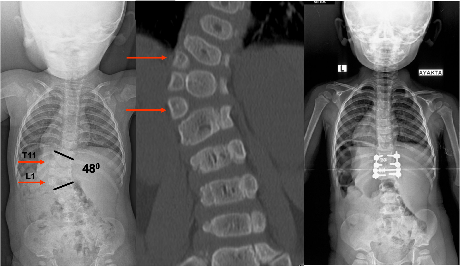vrozhdennye-poroki-pozvonochnika