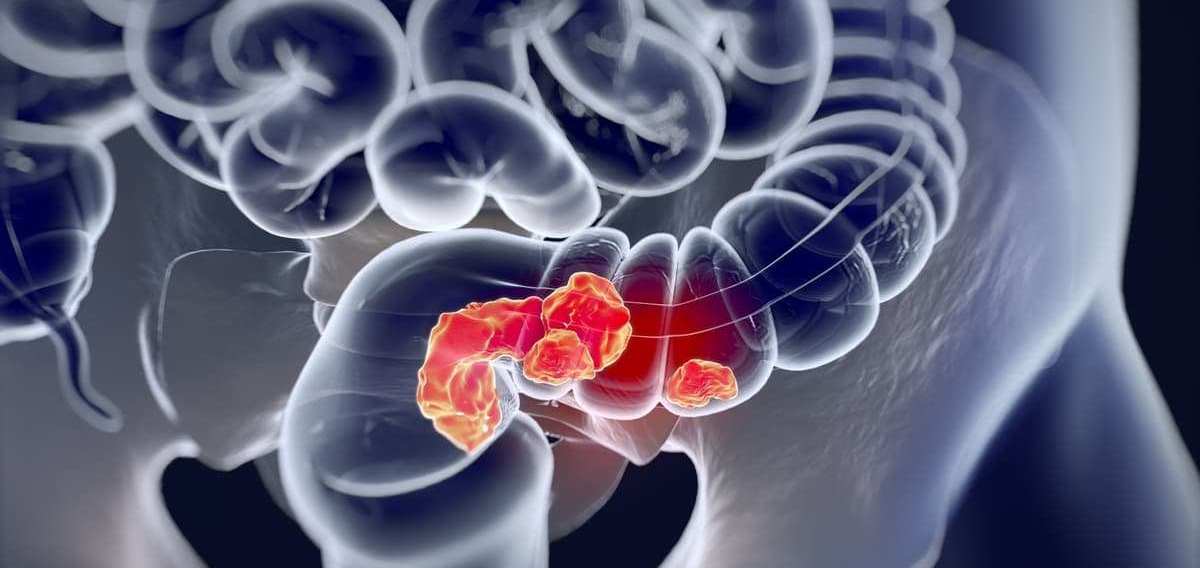 kolorektalnyj-rak-diagnostika-i-lechenie
