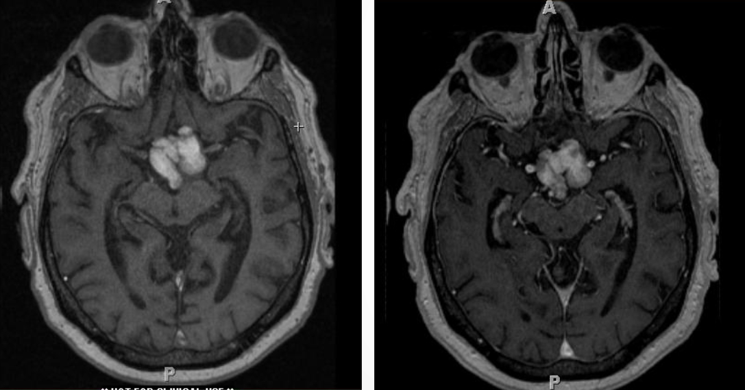 kraniofaringioma