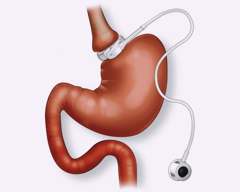 bandazhirovanie-zheludka